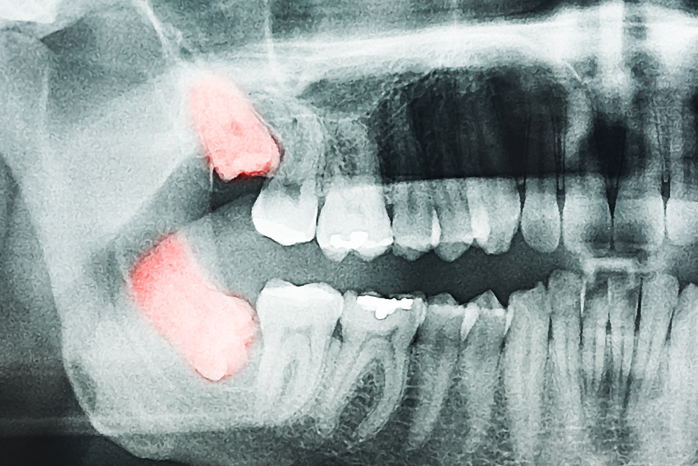 wisdom tooth extraction 